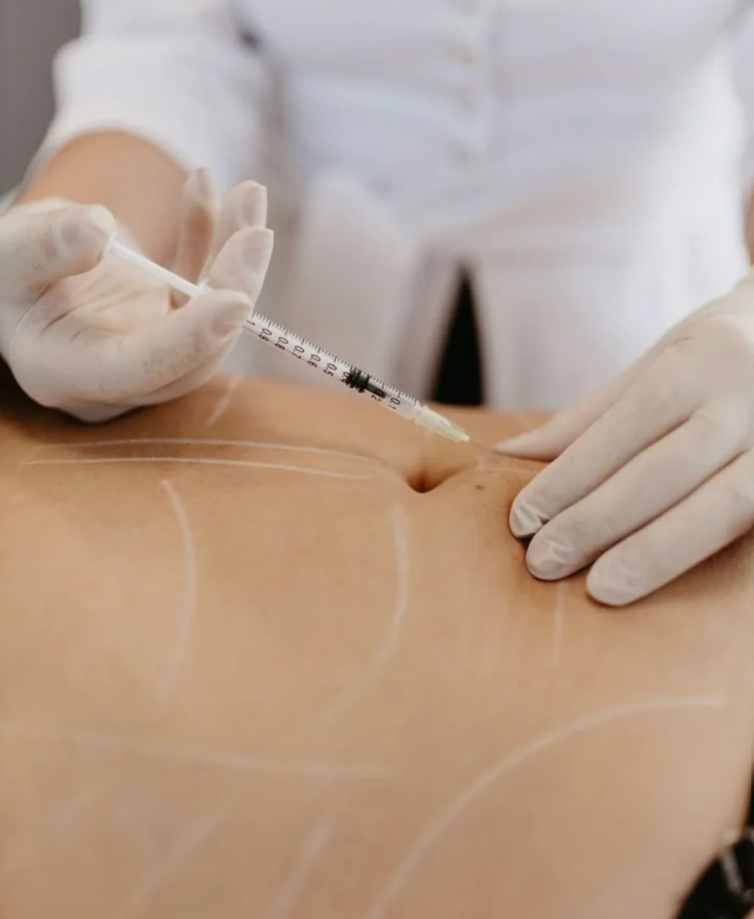 Mesoterapia Corporal