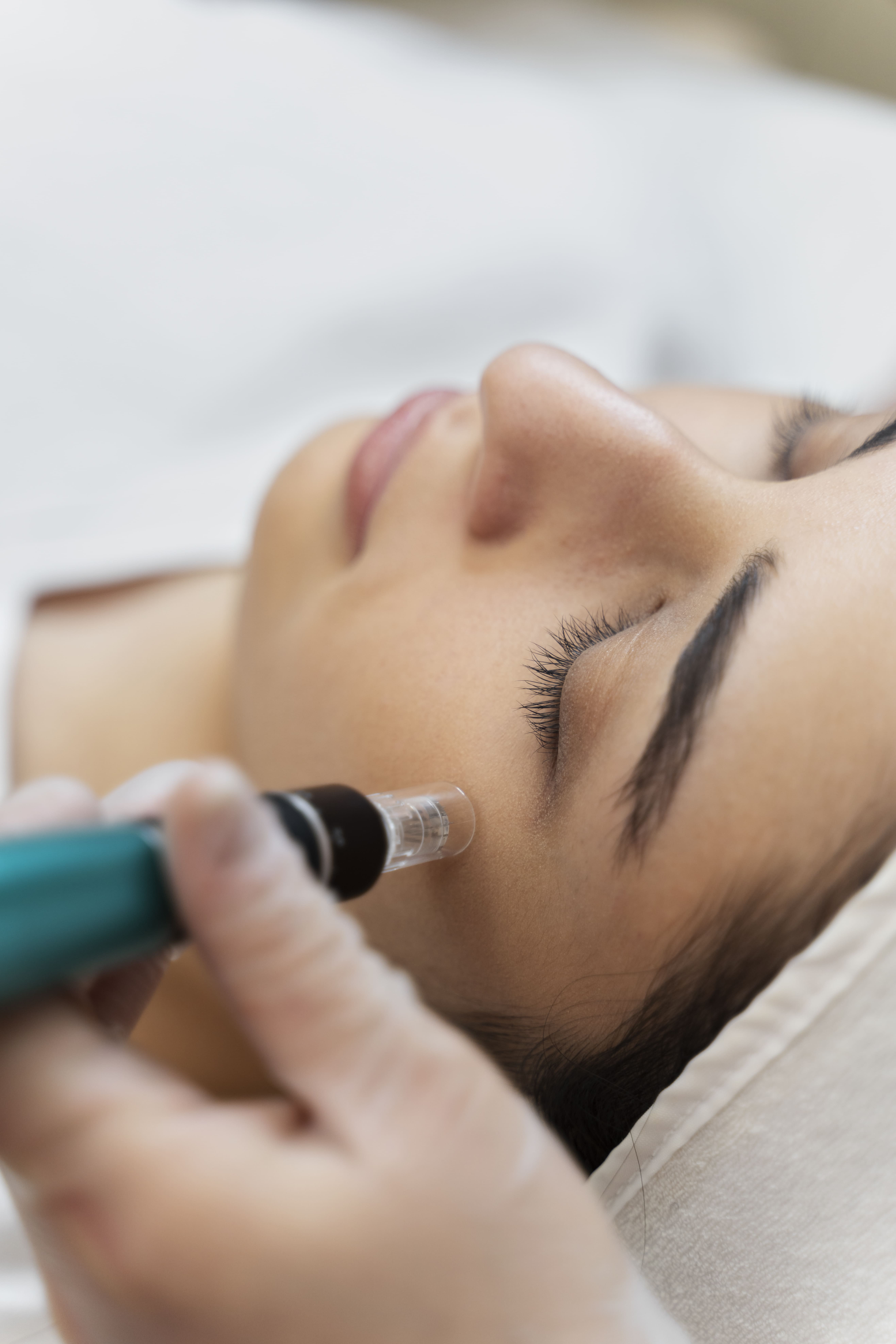 Tratamiento de Microneedling Microneedling
